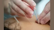 Annie Sturman Acupuncture Phys