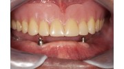 Dentures