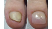 Nail Reconstruction