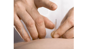 Acupuncture