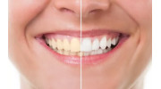 Teeth Whitening