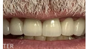 Dental Crowns