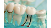 Root Canal