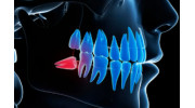 Wisdom Teeth Removal