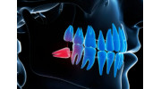 Wisdom Tooth Extraction