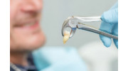 Emergency Extractions