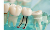 Emergency Root Canals
