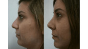 Rhinoplasty