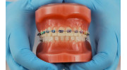 Braces