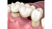 Dental Bridges and Crowns