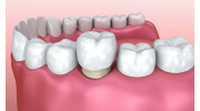 Dental Crowns