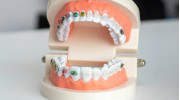 Braces