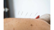 Acupuncture Services