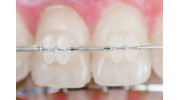 Clear Braces