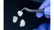 Dental Veneers in Laguna Hills, CA