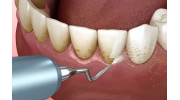 Dental Cleaning in Laguna Hills, CA