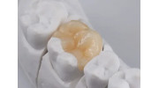 Dental Crowns in Westwood, CA