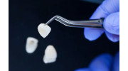 Dental Veneers in Westwood, CA