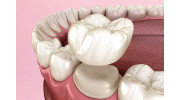 Dental Crowns