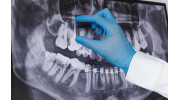 Root Canal Therapy