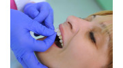 Porcelain Veneers