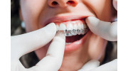 Invisalign Clear Aligners