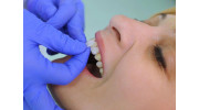Porcelain Veneers