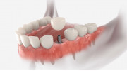 Single-Tooth Implant