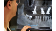 Snap-in Dentures