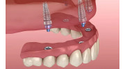 All-on-4 Dental Implants
