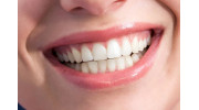 Cosmetic Periodontal Surgery