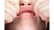 Frenectomy Treatment