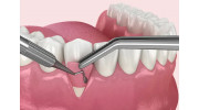 Gum Graft Surgery