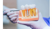 Dental Implants
