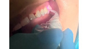 Laser Dentistry