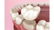 Dental Crowns