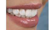 Dental Veneers