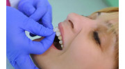 Veneers
