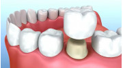 Dental Crowns