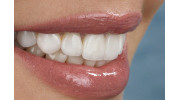 Dental Veneers