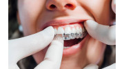 Invisalign Clear Aligners