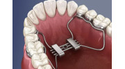 Palatal Expanders