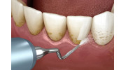 Teeth Cleaning