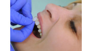 Veneers
