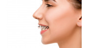 Overbite Treatment