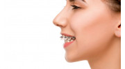 Overbite Treatment