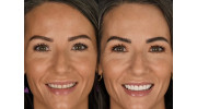 Porcelain Veneers in Bellevue, WA